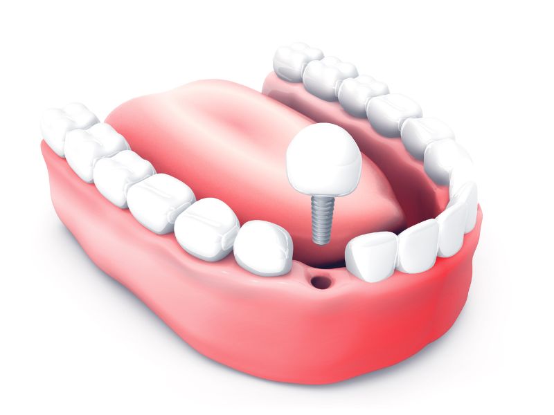 Implantes Dentários